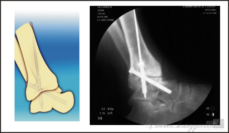 Mid-Range: Ankle illustration showing injury and surgical hardware per medical films